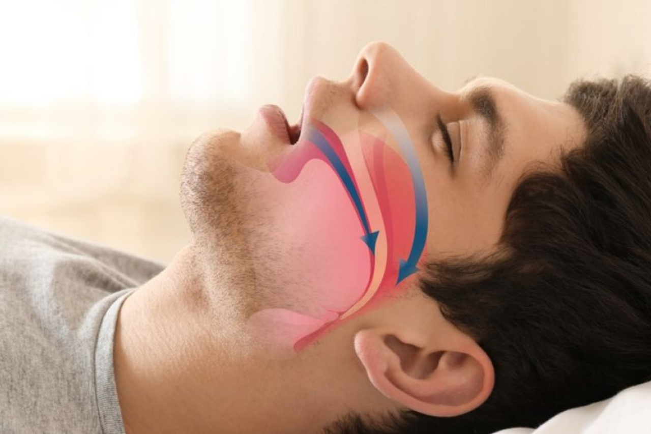 El papel del odontólogo en el tratamiento de la apnea del sueño
